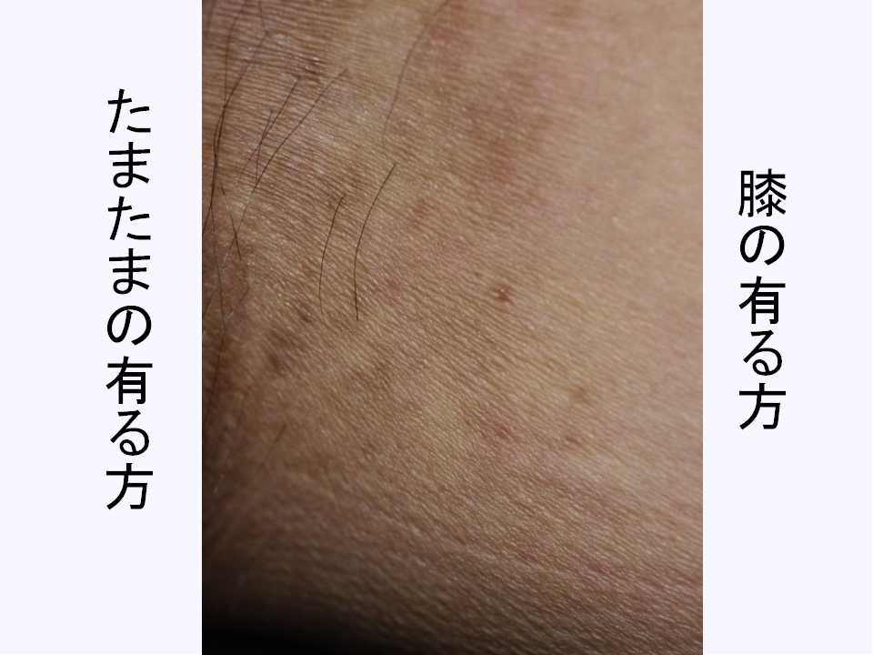 足の付け根がかゆい いこじな皮膚 ニキビ 乾燥 かゆみ等